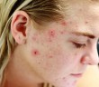 El horror de tener acné sin ser adolescente
