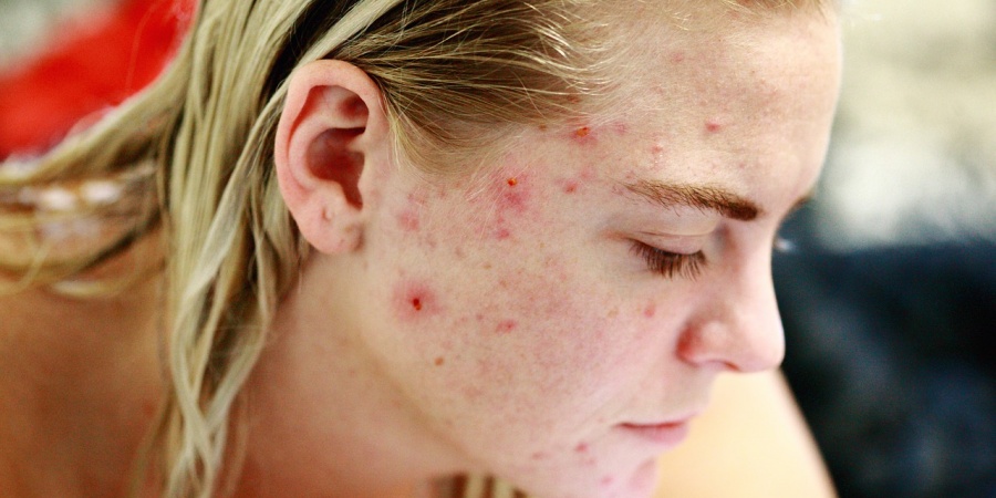 El horror de tener acné sin ser adolescente