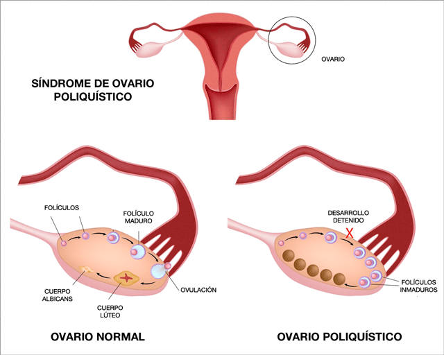 sindrome-de-ovario-poliquistico