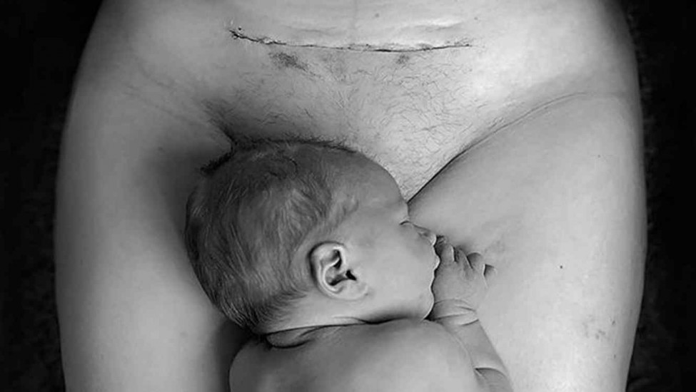 cesarea-bebe-foto-viral