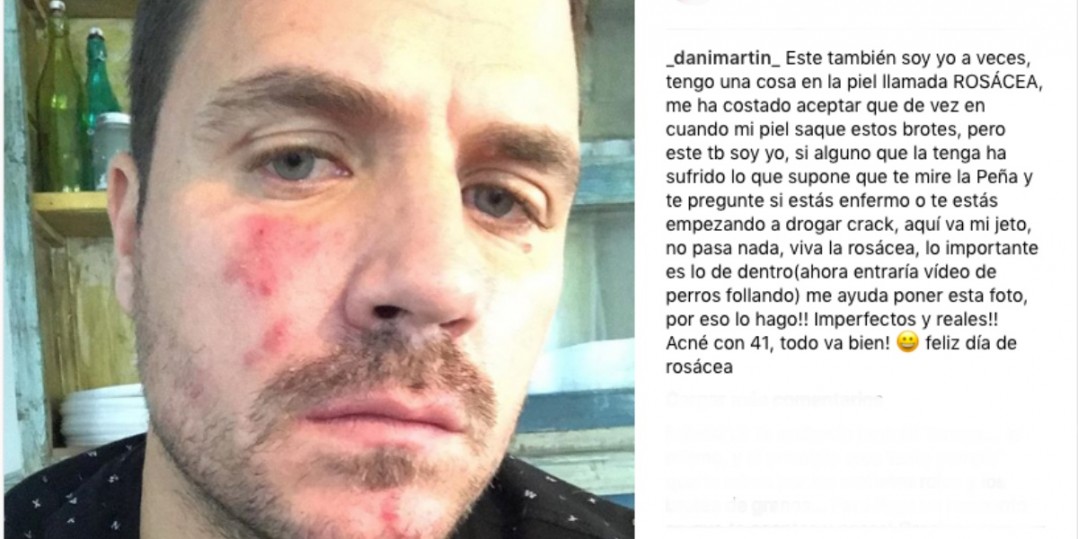 Dani Martín muestra su rosacea en Instagram y nos parece muy guay