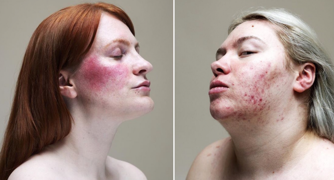 De body a skin positivity: la campaña que te enseña a quererte tengas la piel que tengas