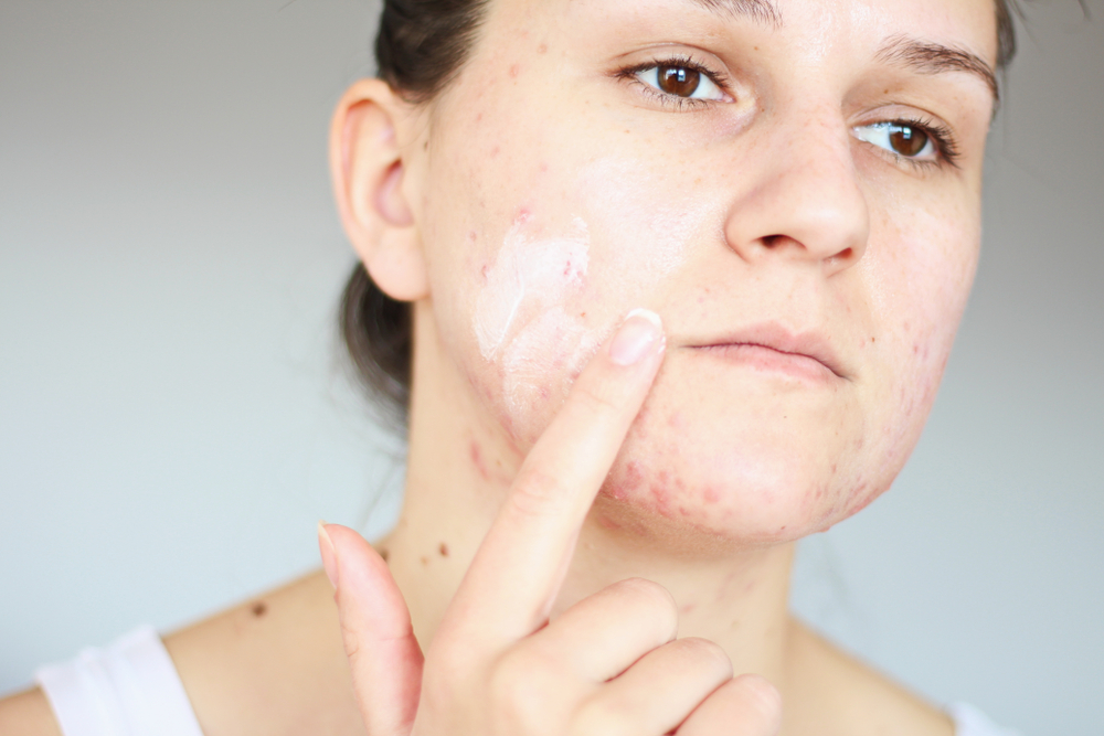 El acné duele y otras cosas que quizás no sabías