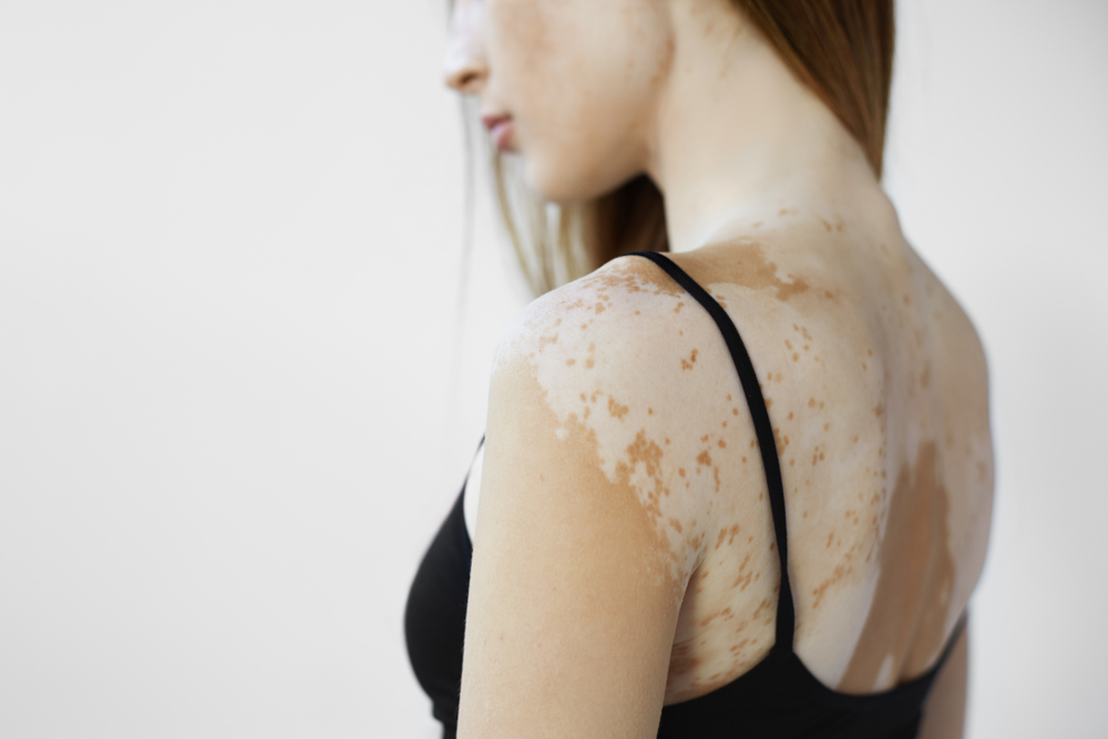 ¿Cómo es la vida de una persona con vitiligo?