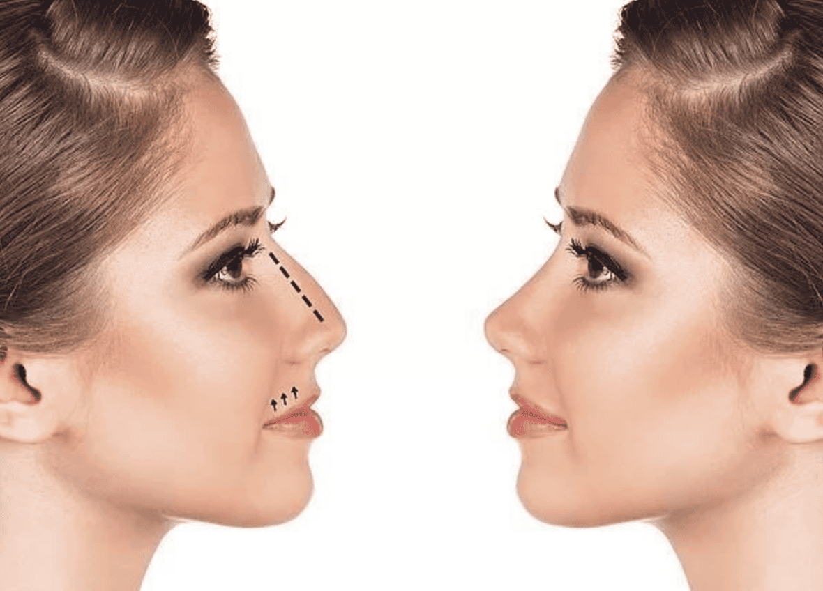 C&oacute;mo la rinoplastia ultras&oacute;nica est&aacute; revolucionando la cirug&iacute;a est&eacute;tica moderna